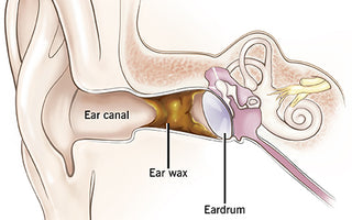 How to Treat Impacted Ear Wax