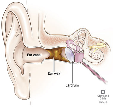 How to Treat Impacted Ear Wax